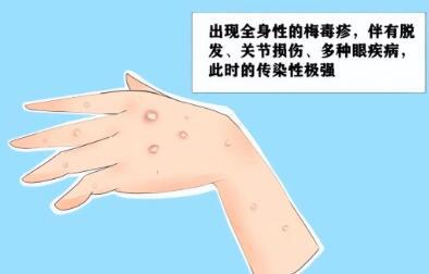 男性怎么判断自己得性疾病了