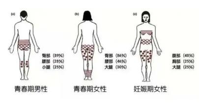 为什么女生大腿附近会有白色条纹