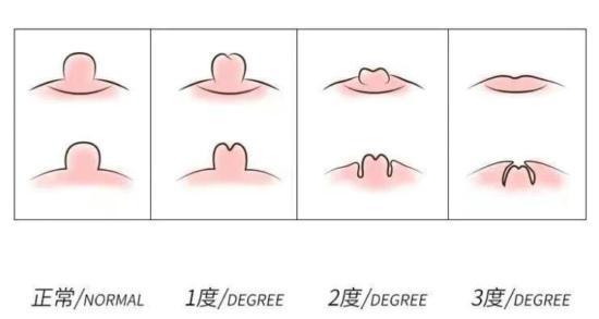女生乳头凹陷是怎么回事