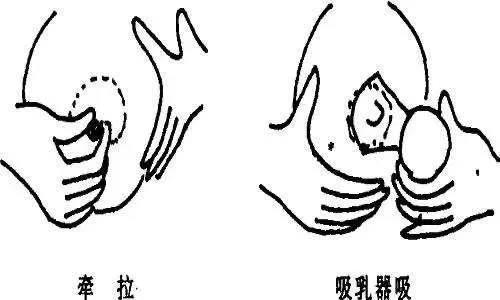 女生乳头凹陷是怎么回事
