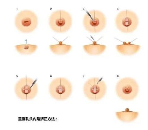 女生乳头凹陷是怎么回事