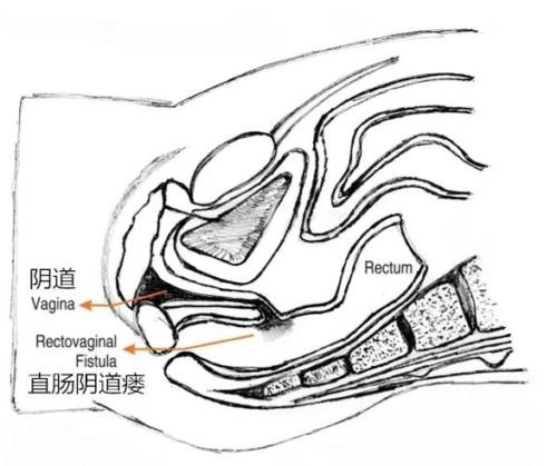 房事的时候下面总有声音,是因为太松了吗