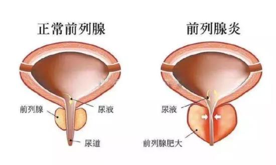 长期没有性生活的男人,到底会发生什么事?