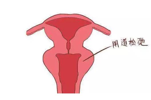女人阴道松弛怎么办?教你两个方法!