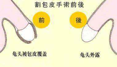 什么时候去割包皮比较合适