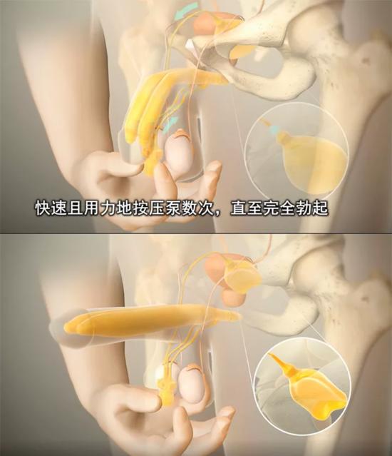 丁丁又软又短怎么办？这个神器让你随心所欲