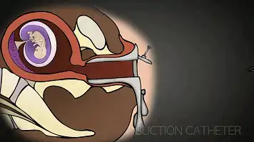 避孕、人流和性知识