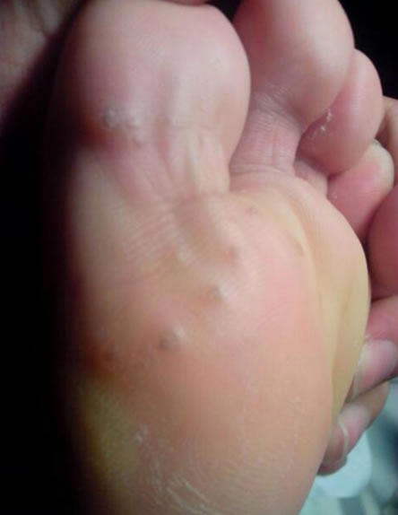 跖疣初期图片 鸡眼和跖疣怎么辩(对比图)