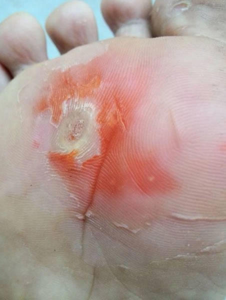 跖疣初期图片 鸡眼和跖疣怎么辩(对比图)