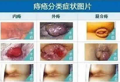 痔疮长什么样子的描述及初期症状真人图片