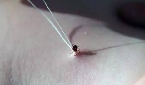 蜱虫图片:家里有蜱虫不小心被咬了怎么办