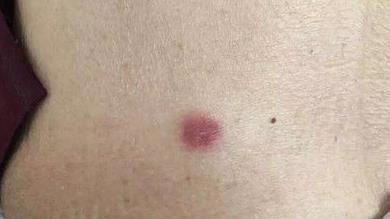 蜱虫图片：家里有蜱虫不小心被咬了怎么办