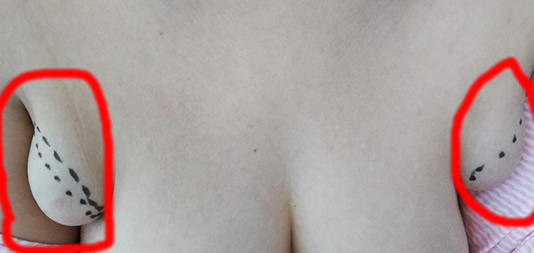 女性副乳长什么样子图片(先天副乳和后天副乳要分清)