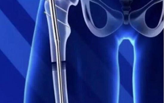 花52万增高15厘米 拉伸式增高真的可以吗