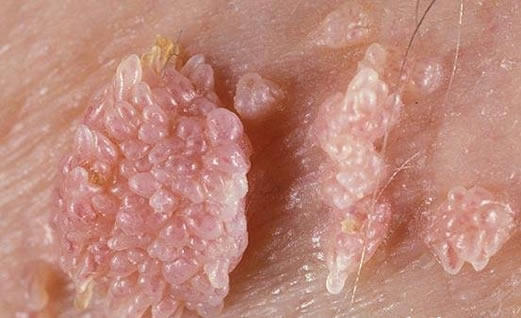 女性hpv病毒女性症状图片 各类型初期小疣体图片