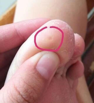 女性hpv病毒女性症状图片 各类型初期小疣体图片