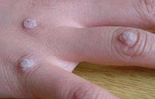 女性hpv病毒女性症状图片 各类型初期小疣体图片