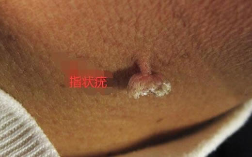 女性hpv病毒女性症状图片 各类型初期小疣体图片