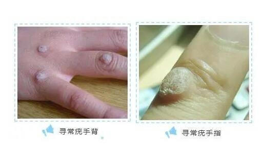 女性hpv病毒女性症状图片 各类型初期小疣体图片