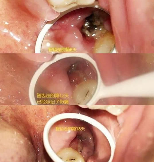 拔牙10天后牙窝状态图(拔牙一周状态及恢复情况)