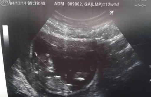 孕期nt单子上有男女标志