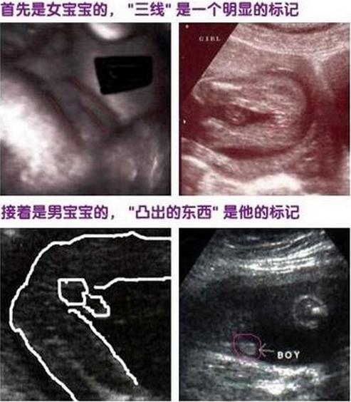 几个月能看出男孩女孩：男孩与女孩b超的区别图片
