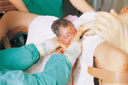 生孩子顺产正面图片大全
